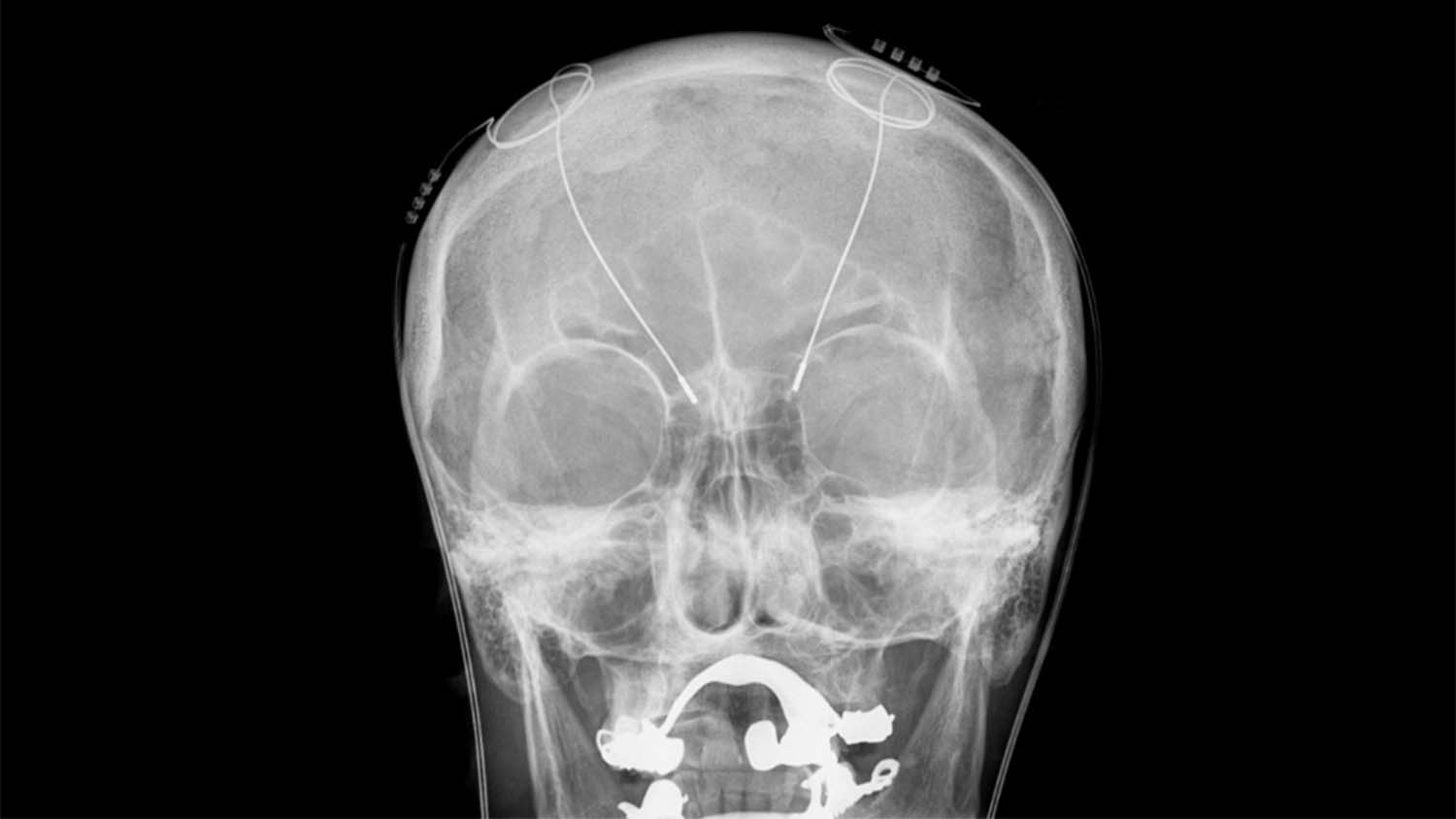 x-ray of head